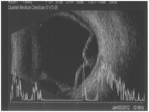 Figure 2 B-scan ultrasonography showing choroidal effusion and chorioretinal detachment.