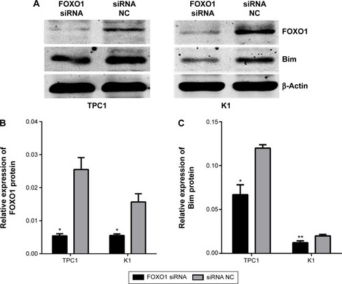 Figure 2 Relative expression of FOXO1 and Bim protein in PTC cells 72 hours after transfection with FOXO1 siRNA and NC RNA (200 nmol/L).