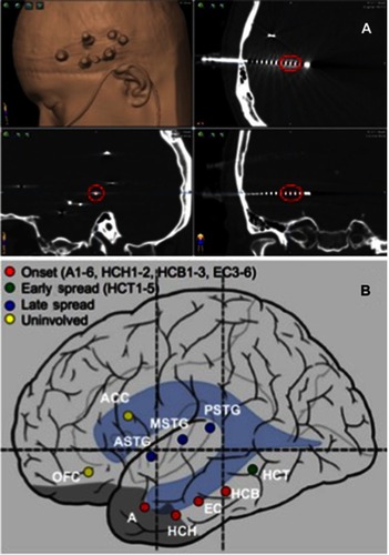 Figure 2 Localization of the epileptogenic zone. (A) A postoperative volumetric CT scan is obtained and used to localize each electrode contact in stereotactic space on the co-registered preoperative MRI. For each seizure recorded, the contacts involved are identified. (B) A summary of the contacts associated with seizure onset, early spread, and late spread is determined at an interdisciplinary epilepsy conference and used to plan further surgical intervention. Nomenclature is by convention. Each trajectory is named during the planning phase and numbers reflect the electrode contacts in order from deep to superficial (eg, A1–6=amygdala electrode contacts 1-6; HCH1–2=hippocampal head electrode contacts 1-2).