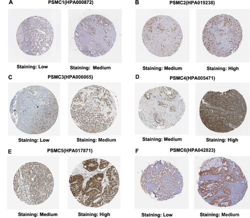 Figure 2 Immunohistochemical analysis showing different protein expression levels of PSMC1 (A), PSMC2 (B), PSMC3 (C), PSMC4 (D), PSMC5 (E), and PSMC6 (F) in HCC tissues. All representative IHC staining images are from the HPA server.