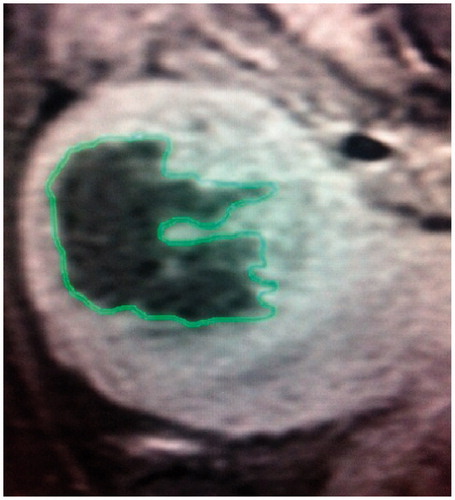 Figure 3. Post-treatment non-perfused volume of the uterine fibroid on T1-weighted MRI.