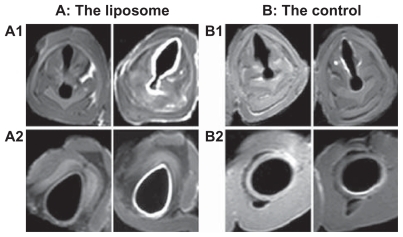 Figure 4 Transverse magnetic resonance images of ex vivo pig laryngeal (A1 and B1) and tracheal (A2 and B2) segments before and after nebulization delivery of lipid-stabilized contrast agent and the control. Left images, before nebulization; right images, after nebulization.