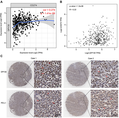 Figure 5 The expression of DPY30 correlates with PD-L1 in human melanoma tissues. (A and B) Spearman correlation analysis of DPY30 expression with CD274 expression. (C) Representative IHC staining of DPY30 and PD-L1 in the same melanoma tissue. Red arrows point to the location of DPY30 protein and PD-L1 protein.