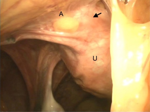 Figure 1 Laparoscopic view of ventrofixed uterus in a case who underwent LAVH.