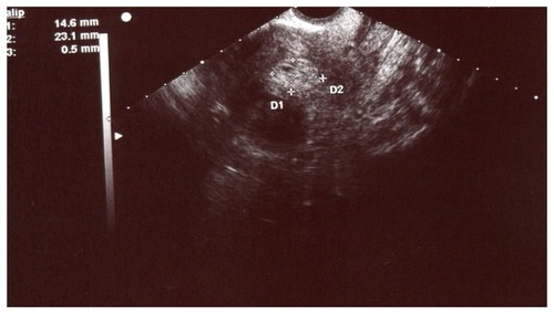 Figure 1 Transverse view at the fundus thought to be of retained products of conception (day 21).