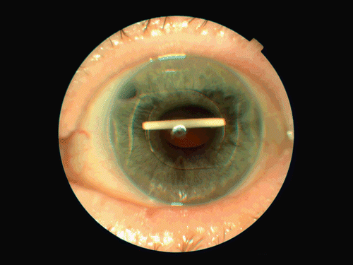 FIGURE 1  Anterior segment photo of the 89 year-old female demonstrating dexamethasone implant migration into the anterior chamber behind the anterior chamber intraocular lens.
