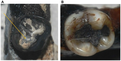 Figure 9 The teeth (A) 47 and (B) 37.