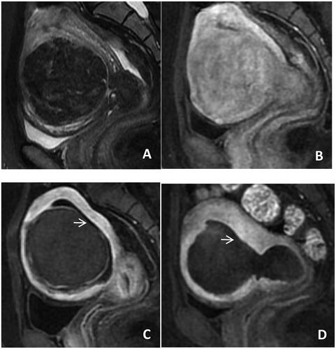 Figure 3. Pre-HIFU, post-HIFU and follow-up MRI images obtained from a patient with type 2–5 submucosal fibroids. (A) The fibroids were located under the mucosa of the anterior wall of the uterus, with low signal intensity on T2WI(Funaki I); (B) Slight to moderate enhancement after T1WI; (C) 100% of the fibroids were ablated after HIFU, there was no enhancement in the mucosa of the fibroids; Endometrium impairmen grade 3(arrow). (D) Three months after HIFU, FVSR was 50%. Excreted fibroid tissue was observed in the cervical canal. On the same day, the patient had abdominal pain and fibroid tissue was discharged through the vagina. Endometrium impairmen grade 3(arrow).