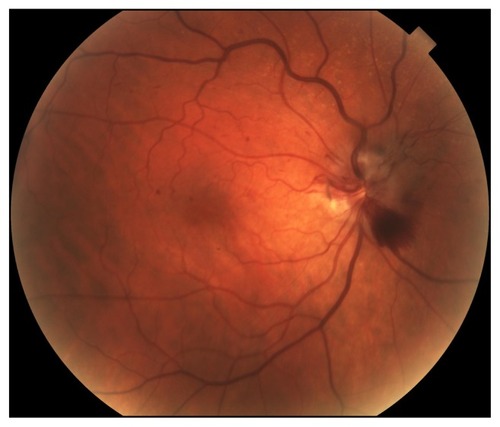 Figure 1 Fundus examination OD at presentation revealing nerve fiber layer swelling at 12 and 6 o’clock, a very distended and tortuous superior branch retinal vein, one flame-shaped peripapillary hemorrhage, and one preretinal hemorrhage alongside areas of ischemia at the inferior pole.