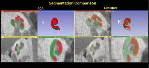 Figure 5 Cochlear segmentation using the new proposed high-resolution atlas in comparison to the low-resolution atlas proposed in ACA (Al-Dhamari et al. Citation2018).