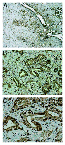 Figure 2. TRPM8 is aberrantly expressed in pancreatic adenocarcinoma. The paraffin-embedded tumor sections from the surgically resected specimen were analyzed by immunohistochemistry using rabbit anti-human TRPM8 antibodies (Lifespan Biosciences) at 1:50 dilution, followed by incubation with horseradish peroxidase-conjugated anti-rabbit IgG (EnVision+ System, Dako). The signals were detected by color reaction using 3,3′-diaminobenzidine (Dako), counterstained with hematoxylin (Richard-Allan Scientific), and mounted using Permount (Sigma). The brown color indicates the presence of TRPM8 protein. Strong immunoreactivity against TRPM8 can be observed in the ductal epithelia of the pancreatic adenocarcinoma, with staining in both plasma membrane and cytoplasm. There is heterogeneity for expression of TRPM8 in the tumor. (A) 40x magnification. (B) 200x magnification. (C) 400x magnification. Tissue sections incubated in the absence of anti-TRPM8 antibodies were processed in parallel as control, and they did not exhibit any detectable immunoreactivity against TRPM8 (data not shown).