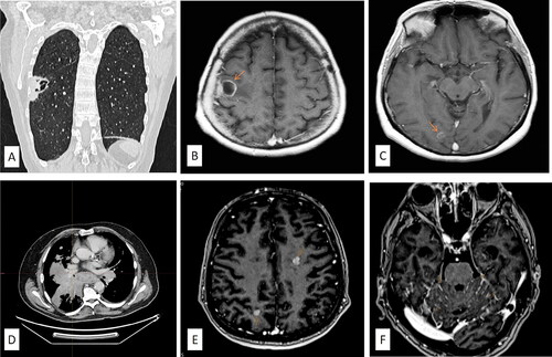 Figure 1. (A) The initial CT scan of the lungs showed the presence of a tumour mass in the right lower lung lobe. (B, C) The MRI scan of the brain during the initial presentation of the patient with symptoms of left hemiparesis revealed the presence of three metastases in the brain. (D) CT scan of transformed SCLC cancer after progression on immunotherapy with pembrolizumab. (E, F) The MRI scan of the brain reveals new metastatic deposits (arrows in the MRI scans indicate metastatic deposits).