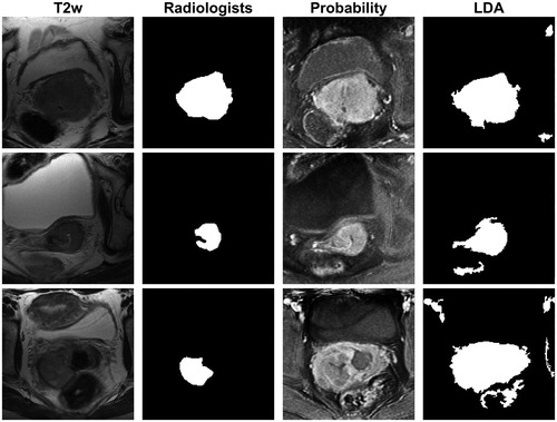 Figure 4. The T2w image (first column) and the radiologists’ mask (second column) for image slices from three different patients. The tumour probability maps (third column) and the binary masks (fourth column) derived from the LDA model based on all image types with eight neighbour voxels included, using autoscaling as image pre-processing (Table 1, bold). In the tumour probability maps, black and white indicate 0% and 100% predicted probability, respectively, of the voxel belonging to the tumour. The agreement between the radiologists’ mask and the LDA binary mask given by the Dice similarity coefficient (DSC) was for these image slices 0.82 (first row), 0.57 (middle row) and 0.31 (last row).