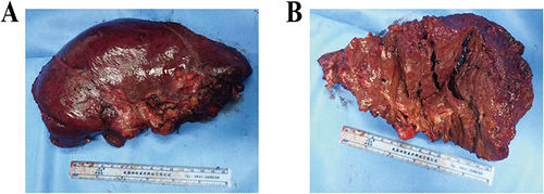 Figure 8 The second hepatectomy specimen. (A and B) show part of liver in segment V and all of segment VI and VII.