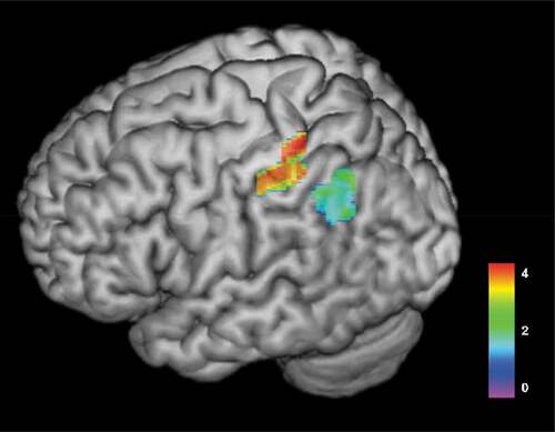 Figure 2. Colorized 3D render map of results from VLSM-analysis of associations between lesioned areas at T1 and aphasia severity at T3 (n = 23). The map illustrates that warmer areas (red) have a strong association to aphasia severity in patients with aphasia. T-test range = −1.263–4.336, FDR-corrected Z score with permutations = 3.61, p < .05. Areas significantly associated with aphasia severity at 12 months post-stroke included the postcentral gyrus (MNI = −31x-35x54, Z score = 3.681) and the inferior parietal gyrus (MNI −31x-35x44 Z score = 3.681)