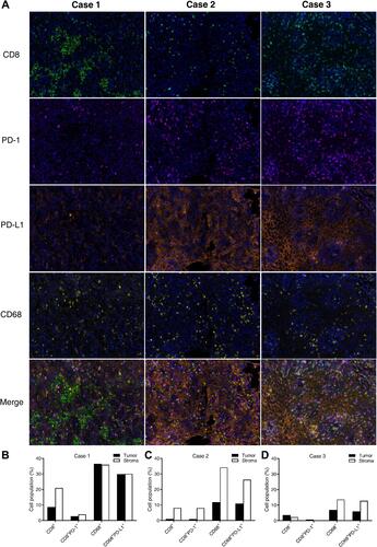 Figure 2 Tumor immune microenvironment characteristics of the three oral squamous cell carcinoma patients. (A) Representative images of CD8, PD-1, PD-L1, CD68 shown by multiplex immunohistochemistry (mIHC) in pre-treatment tumors of Case 1/2/3. Magnification, ×200. (B–D) Quantitative analyses of mIHC data from 15 random vision fields of Case 1 (B), Case 2 (C) and Case 3 (D).