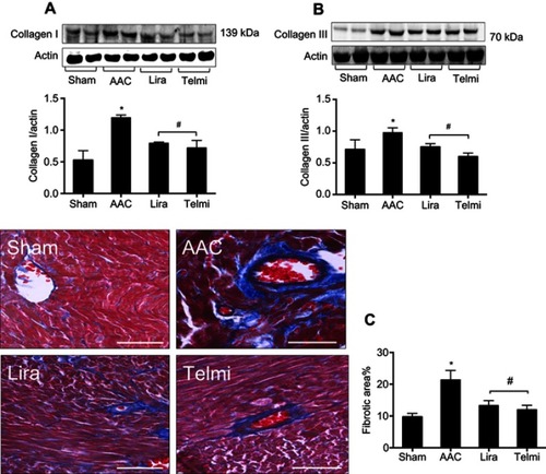 Figure 5 Effects of liraglutide and telmisartan on the synthesis of collagens and tissue fibrosis after AAC. (A and B) Protein levels of collagens I and III were analyzed by Western blot assay. All bands were normalized by actin as illustrated in the bar graphs. (C) Interstitial and perivascular fibrosis in the myocardium was identified as collagen deposition shown as positive areas of blue staining using Masson’s trichrome method. All images were viewed under magnification 200 (scale bars: 100 μm). Values are mean±SEM (n=6/group). *p<0.05 AAC vs Sham; #p<0.05 Lira or Telmi vs AAC.