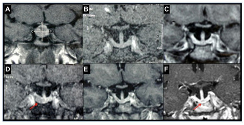 Figure 1 Follow-up magnetic resonance images showing changes in tumor size during different treatment regimes in a patient with acromegaly.