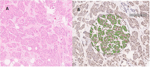 Figure 1 Invasive breast carcinoma according to TAILORx risk categorization (ODX-RS: 32 and MCM-2 level: 75%).
