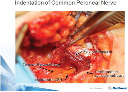 Figure 2. Indentation of common peroneal nerve at R fibular neck is noted just after decompression by division of peroneus longus fascia and a few muscle fibers. Magnification = 1.5×. Patella at 12 o’clock direction, foot to 4:30. With permission of Dr. S. Barrett, Phoenix, AZ.