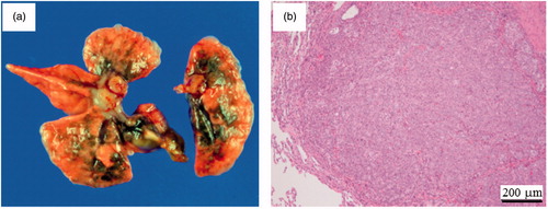 Figure 7. A bronchiolo-alveolar carcinoma 104 weeks after instillation with short SWCNT-3. Necropsy photograph for the lung (a) and histopathological specimen (b).