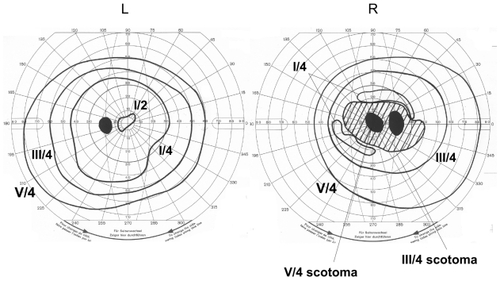 Figure 2 Goldmann perimetry showing a central scotoma in the right eye. The visual field of left eye is normal.