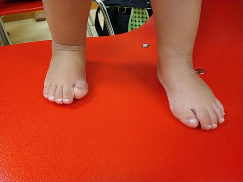 Figure 1 Bilateral, congenital malformed great toes in a 2-year-old child with fibrodysplasia ossificans progressiva. Both great toes show typical shortening and are angled inward (hallux valgus).