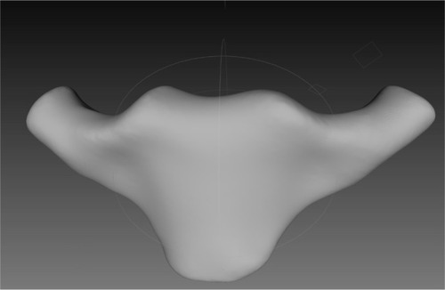 Figure 2 3D model of the implant prepared based on software program including the date of the patient’s computed tomography scan.