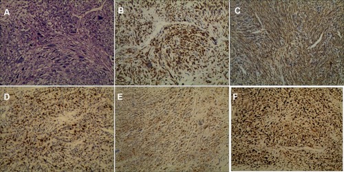 Figure 2 Immunostaining of the resected lesion. (A) Under the microscope, the tissue illustrated a remarkably uniform histological feature (hematoxylin and eosin, ×100). Immunohistochemical staining showed the tumor was strong positive for Desmin (×100) (B), Myoglobin (×100) (C), Myogenin (×100) (D), S-100 (×100) (E), and Ki-67 (×100) (F), which the Ki-67 index was 30%. The tumor was negative for other markers.