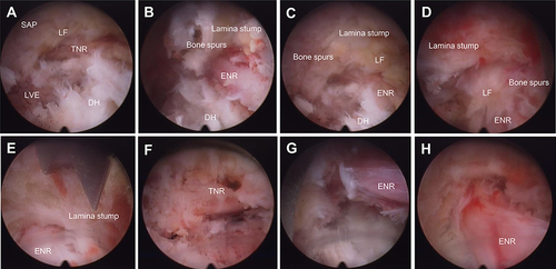 Figure 2 Intraoperative endoscopic views. (A) Identification of the S1 TNR. (B–D) Identification of the L5 ENR, showcasing pathology of L5 ENR compression, including bone spurs extending from the proximal lamina stump, bone spurs at the edge of the foramen, LF, and DH. (E) Execution of endoscopic lumbar foraminotomy using an endoscopic bone knife to eliminate pathological bone factors around the ENR. Complete decompression of the TNR (F) and ENR (G and H) and the dural exposure from the starting point to ENR.