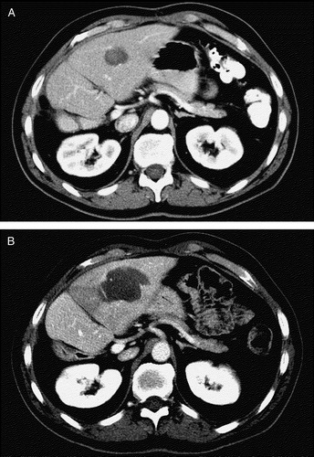 Figure 1.  (a) Recurrent colorectal metastasis of the liver in a patient who had already undegone a partial resection of the right lobe. A helical CT scan shows a hypoattenuating lesion 2.7 cm in diameter in segment 3 of the left lobe.