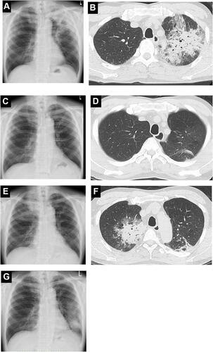 Figure 1 (A, B) Chest X-ray and chest CT scan in October 2012. Patchy infiltrations predominantly around the pleura with air bronchograms in the left upper lobe are seen. (C, D) Chest X-ray and chest CT scan in February 2013. Dramatic improvement is seen. (E, F) Chest X-ray and chest CT scan in April 2013. Relapse of CEP showing infiltration in right upper lobe is shown. (G) Chest X-ray in August 2015. Infiltrative shadow in left lower lung field is seen.