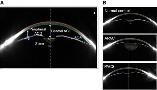 Figure 1 Biometric variables, including central anterior chamber depth (ACD), peripheral ACD, anterior chamber angle (ACA), and anterior chamber volume (ACV), were measured with a Pentacam (A). Representative images for a normal eye, an eye with APAC, and an eye with PACS (B).Abbreviations: APAC, acute primary angle- closure; PACS, primary angle-closure suspect.