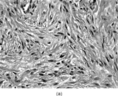 FIG. 5 Inclusion body fibromatosis (congenitalinfantile digital fibromatosis) is composed of bland fibroblastic cells arranged into sheets and fascicles with abundant collagen matrix (a, original magnification × 200, H&E). Trichrome (b, original magnification × 400) and smooth muscle actin (c, original magnification × 200) staining may reveal oval cytoplasmic bodies with the spindle cells. Upon ultrastructural examination, these cytoplasmic bodies prove to be whorls of actin filaments that are characteristic for this specific fibroblastic tumor (d, original magnification × 5,000).