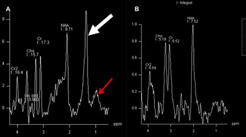Figure 2 Magnetic resonance spectroscopy of white matter reveals a prominent peak at 1.3 ppm (thick arrow) and also at 0.9 ppm (thin arrow) Figure 2A) in a child with Sjogren Larsson syndrome compared to age matched control (Figure 2B).