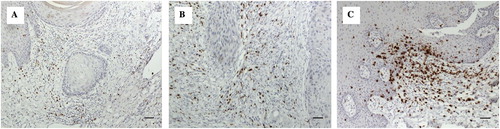 Figure 2. Showing immunhistochemistry (IHC) staining with 3,3′-Diaminobenzidine (DAB) chromogen of selected antibodies (brown staining). (A) OSCC group: CD8+ cells were sparsely distributed in the deeper connective tissue (x200, bar: 50 m). (B) OSCC group: Moderate numbers of CD8+ cells around strands and islands of malignant keratinocytes (x200, bar: 50 m). (C) Control group: The frequency and intensity of staining was more than in OSCC sections with focal collections of CD8+ cells in the control tissues in comparison to the sparse distribution in OSCC sections (x200, bar: 50 m).