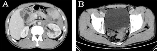 Figure 1. Contrast-enhanced computed tomography (CT) scan. CT scan showed retroperitoneal masses involved in the pancreatic tail surrounding adjacent blood vessels (A) and a mass in rectum (B).