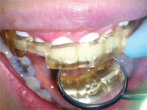 Figure 23. Intra operative view of endo guide in patient’s mouth.