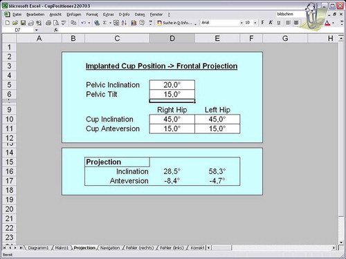 Figure 5. Microsoft Excel program screenshot showing the results of calculating the projected cup positions in a pelvis with 20° of inclination and left hip elevated 15°.