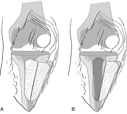 Figure 2. Intramedullary and extramedullary TTO A. Diagram illustrating a TTO elevated in a medial to lateral fashion. The anterior compartment muscles as well as the patellar tendon and patella are attached to the osteotomized bone fragment. The osteotomy is performed through the metaphyseal bone anterior to the tibial intramedullary canal, exposing cancellous bone on both sides of the osteotomy. B. Diagram illustrating extension of the osteotomy into the intramedullary canal to facilitate tibial stem and cement removal. Cancellous bone has been removed from the proximal tibia to expose the intramedullary canal.