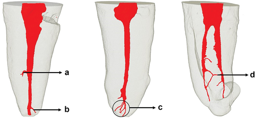 Figure 3. Anatomical variations and ramifications of mandibular premolars using micro-ct. (a).Lateral canal. (b). Secondary canal. (c). Apical delta. (d). Intercanal.