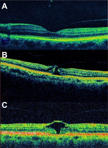 Figure 5 Full-thickness macular hole classification.