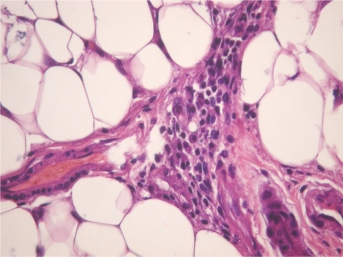 Figure 4 An omentum biopsy shows chronic inflammatory cell infiltration and congestion.
