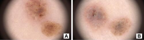 Figure 5 Typical dermoscope appearance of seborrheic keratosis. (A) Before HIFU treatment. (B) Directly after treatment. Whitening of the epidermis and denaturation of the superficial skin structure as a reaction to the thermal and mechanical effects of HIFU can be observed.