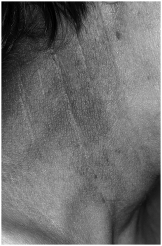 Figure 1. Acanthosis nigricans. Gray-brown to black lesions, rough, thickened plaques and prominent skin lines.