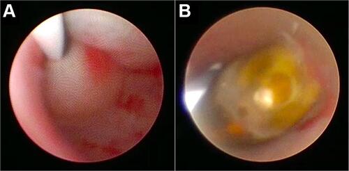 Figure 3 (A) Ureteral stenosis in the distal part of the stone from URS visualization; (B) right proximal ureteral stone from URS visualization.