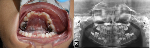 Figure 1 Intraoral examination and imaging. (A) (to the left) The patient’s oral cavity revealing multiple dental caries, and candida infection on her tongue. (B) (to the right) Panoramic x-ray image of the patient’s teeth.