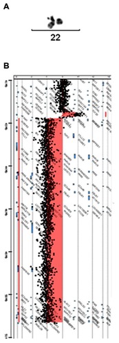 Figure 2 Characterization of the deletion: cytogenetic and molecular studies. (A) Conventional G-banding chromosome 22. The deleted chromosome is on the right. (B) CGH-array. Reduced dosage for probes is shown to the left of the control two-copy line and increased dosage is shown to the right.