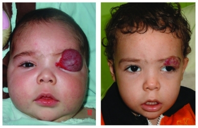 Figure 1 A large upper-lid hemangioma prior to and 4 months after treatment.