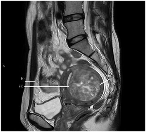 Figure 1. MRI sagittal view of a patient with uterine fibroid. (a) the distance from ventral surface of the fibroid to skin, (b) the distance from dorsal surface of the fibroid to sacrum, (c) thickness of abdominal wall.